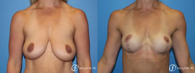 Breast Lift result at Stacey Folk, MD in Denver, CO