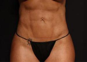 Restora Austin Plastic Surgery Centre liposuction after — Austin, TX