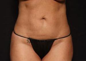 Liposuction before at Restora Austin Plastic Surgery Centre in Austin, TX