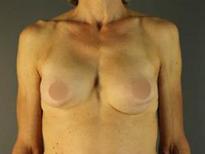 Breast Augmentation before at Restora Austin Plastic Surgery Centre in Austin, TX