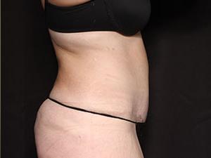 Tummy Tuck after at Restora Austin Plastic Surgery Centre in Austin, TX