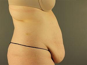 Tummy Tuck before at Restora Austin Plastic Surgery Centre in Austin, TX