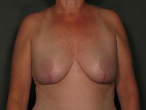 Breast Reduction after at Restora Austin Plastic Surgery Centre in Austin, TX