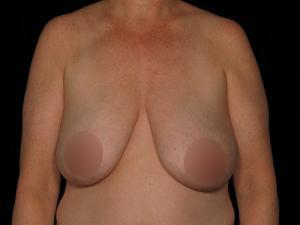 Breast Reduction before at Restora Austin Plastic Surgery Centre in Austin, TX