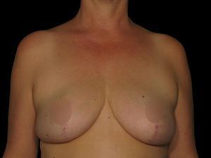 Breast Reduction after at Restora Austin Plastic Surgery Centre in Austin, TX