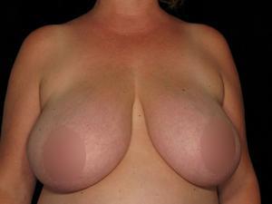 Breast Reduction before at Restora Austin Plastic Surgery Centre in Austin, TX