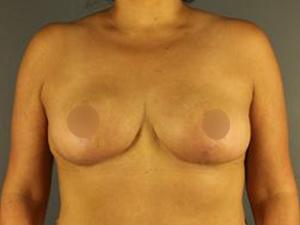 Restora Austin Plastic Surgery Centre breast lift after — Austin, TX
