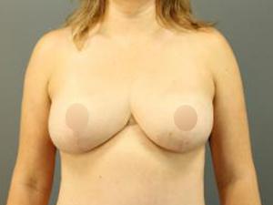 Restora Austin Plastic Surgery Centre breast lift after — Austin, TX