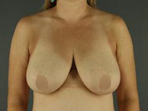 Breast Lift before at Restora Austin Plastic Surgery Centre in Austin, TX