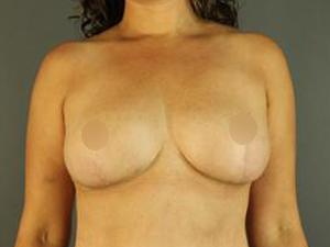 Breast Lift after at Restora Austin Plastic Surgery Centre in Austin, TX