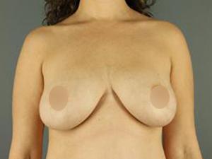 Breast Lift before at Restora Austin Plastic Surgery Centre in Austin, TX