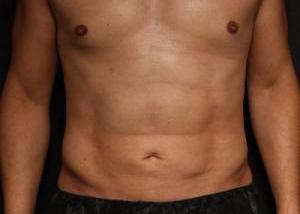 Restora Austin Plastic Surgery Centre liposuction after — Austin, TX