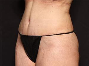 Mini Tummy Tuck after at Restora Austin Plastic Surgery Centre in Austin, TX