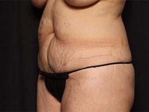 Mini Tummy Tuck before at Restora Austin Plastic Surgery Centre in Austin, TX