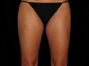 Restora Austin Plastic Surgery Centre liposuction after — Austin, TX