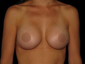 Breast Augmentation after at Restora Austin Plastic Surgery Centre in Austin, TX