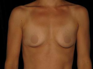 Breast Augmentation before at Restora Austin Plastic Surgery Centre in Austin, TX