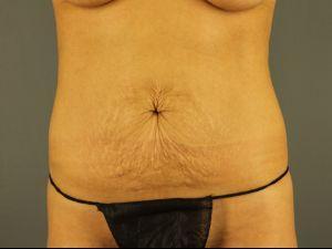 Tummy Tuck before at Restora Austin Plastic Surgery Centre in Austin, TX
