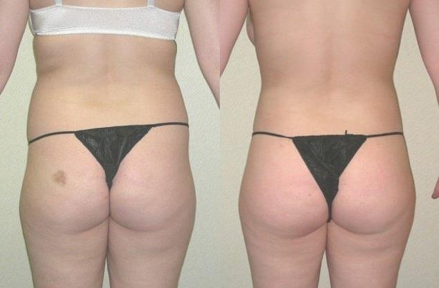 Ganchi Plastic Surgery bbl result — Wayne, NJ