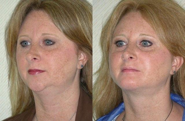 Ganchi Plastic Surgery neck liposuction result — Wayne, NJ