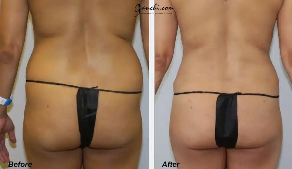 Ganchi Plastic Surgery liposuction result — Wayne, NJ