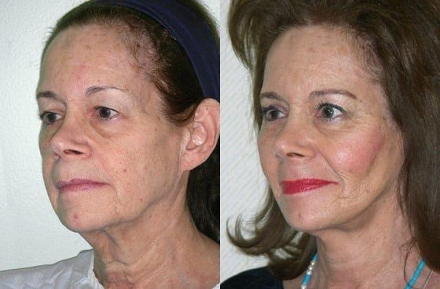 Ganchi Plastic Surgery facelift result — Wayne, NJ