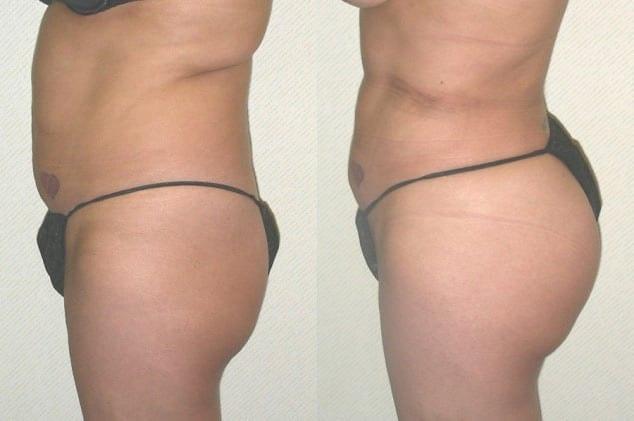 Ganchi Plastic Surgery bbl result — Wayne, NJ
