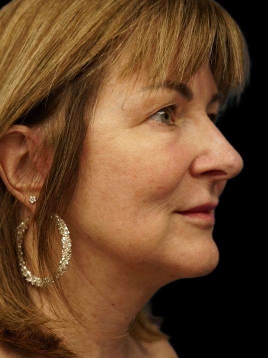 Facelift after at Dr. Petti in Los Angeles, CA