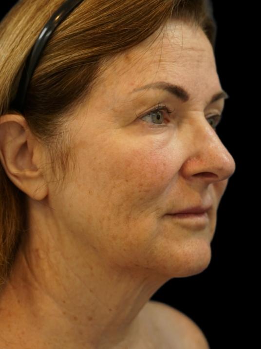 Facelift before at Dr. Petti in Los Angeles, CA