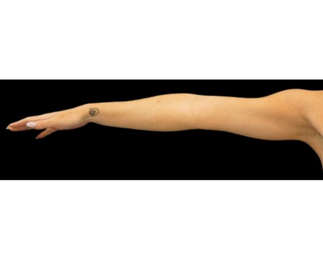 Liposuction before at Dr. Petti in Los Angeles, CA