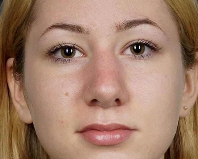 Rhinoplasty after at Dr. Petti in Los Angeles, CA