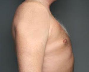 Gynecomastia Surgery after at Dr. Petti in Los Angeles, CA