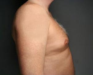 Gynecomastia Surgery before at Dr. Petti in Los Angeles, CA