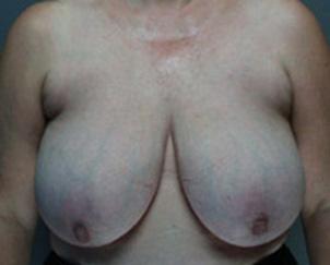 Breast Reduction before at Dr. Petti in Los Angeles, CA