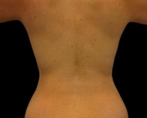 Dr. Petti liposuction after — Los Angeles, CA