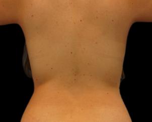 Liposuction before at Dr. Petti in Los Angeles, CA