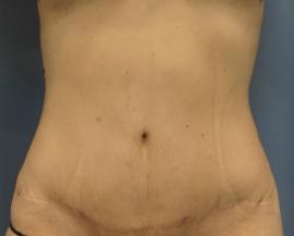 Dr. Petti liposuction after — Los Angeles, CA