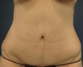 Liposuction before at Dr. Petti in Los Angeles, CA