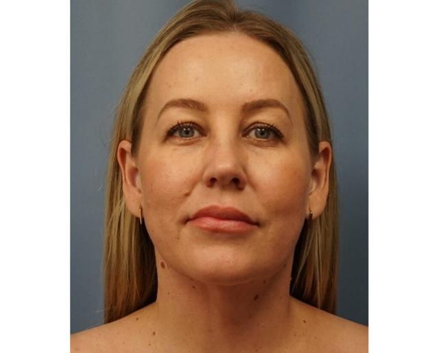 Neck Lift after at Dr. Petti in Los Angeles, CA