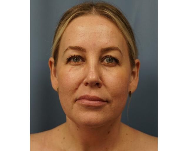Neck Lift before at Dr. Petti in Los Angeles, CA