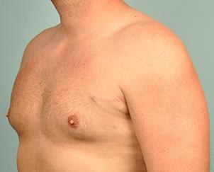 Dr. Petti gynecomastia after — Los Angeles, CA