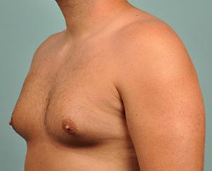 Gynecomastia Surgery before at Dr. Petti in Los Angeles, CA