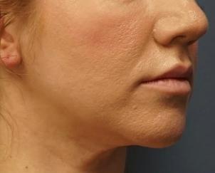 Neck Lift after at Dr. Petti in Los Angeles, CA