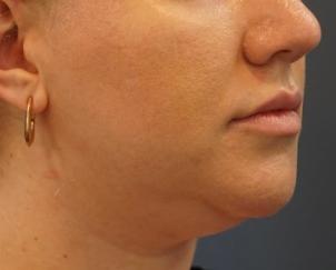 Neck Lift before at Dr. Petti in Los Angeles, CA