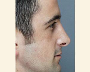 Dr. Petti rhinoplasty after — Los Angeles, CA