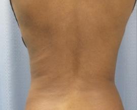 Dr. Petti liposuction after — Los Angeles, CA