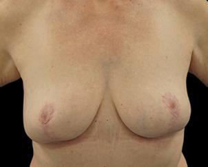 Breast Lift after at Dr. Petti in Los Angeles, CA