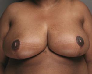Breast Reduction after at Dr. Petti in Los Angeles, CA