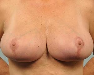Breast Lift after at Dr. Petti in Los Angeles, CA