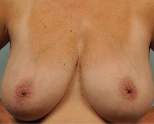 Breast Lift before at Dr. Petti in Los Angeles, CA